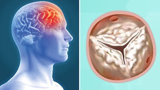 Heart Valve Calcification amp Stroke Risk What Should Patients Know [upl. by Arbuckle]