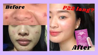 ANTIACNE PILL  LACTEZIN 💊  1 WEEK REVIEW ♡ [upl. by Helman]