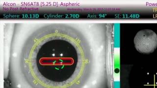 Understanding ORA Intraoperative Aberrometry at UCLA [upl. by Caritta187]