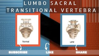 LUMBOSACRAL TRANSITIONAL VERTEBRAE  LSTV  LUMBARIZATION  SACRALIZATION  BERTOLOTTI SYNDROME [upl. by Leihcar]