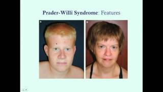 PraderWilli Syndrome  CRASH Medical Review Series [upl. by Kcirad855]