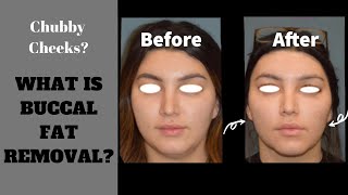 Buccal Fat Removal The Most Common Questions [upl. by Yentihw523]