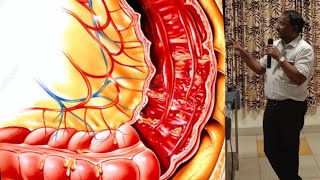 Bacillary Dysentery SHIGELLOSIS [upl. by Navinod]