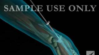 Endoscopic Carpal Tunnel Release Procedure [upl. by Fulvia917]