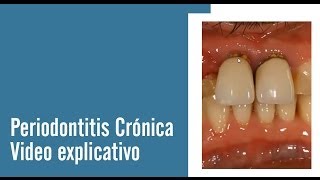 Periodontitis Crónica  Juan Salgado  Enfermedades Periodontales  Video explicativo [upl. by Nonnahsal372]