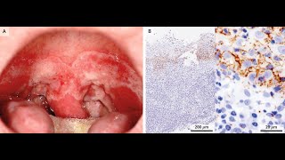 Syphilitische Pharyngitis [upl. by Mart]