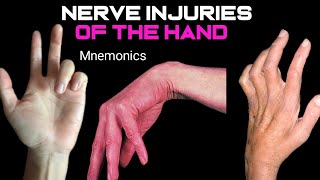 Claw HandWrist DropApe Hand in Urdu and HindiNerves injuries of the hand Nerve mbbsusmile [upl. by Nahshun]