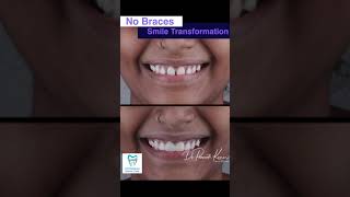 No Braces Teeth Gaps Closure In One Visit  By DrPraneeth [upl. by Bordiuk831]