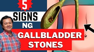 5 Warning Signs ng Gallbladder Stones na Hindi Mo Alam  Payo ni Doc Willie Ong [upl. by Westland]