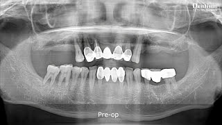 Intentional sinus perforation and pus drainage  Dr Park Wonbae Short [upl. by Ivonne]