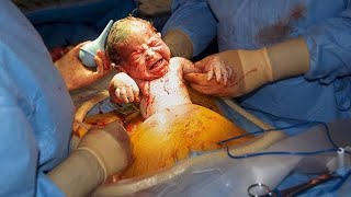 Csection Cesarean Delivery [upl. by Eelesor]