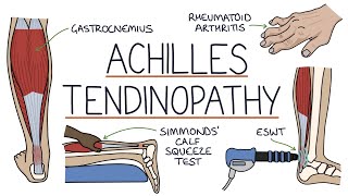 Understanding Achilles Tendinopathy Achilles Tendinitis [upl. by Henrion]