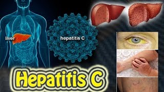 hepatitis c liver disease Harib Diagnostic Lab [upl. by Enyawd417]