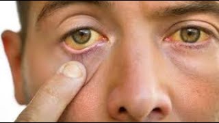 Adult Jaundice Symptoms and Causes  Diagnosis  Treatment  Prevention [upl. by Siednarb594]