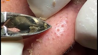 Best Satisfying Nose Plucking Blackheads Whiteheads Removal  Acne Treatment 13 [upl. by Wyatan]