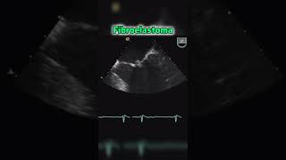 Fibroelastoma of Mitral valve echocardiography heart 2decho [upl. by Sonitnatsnok149]