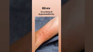 What Are Hives HivesUrticariaAllergyReliefSkinCareChronicHivesItchySkin [upl. by Elbag]