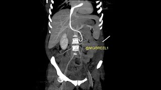 Intracardiac migration of ureteral doubleJ stent till the PV level [upl. by Corney760]