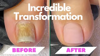 Incredible Toenail Transformation with NanoFlex by Fuzion [upl. by Cyrille826]