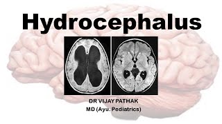 Hydrocephalus CSF Congenital hydrocephalus Acquired hydrocephalus aiapget2022 kaumarabhritya [upl. by Thibaut]