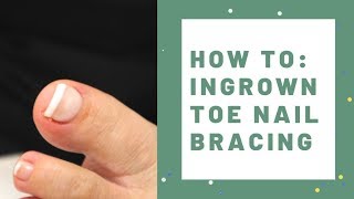 LCN Ingrown Toe Nail Bracing [upl. by Medeah]