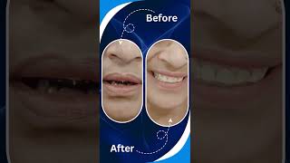 Lower Jaw Teeth Rehabilitation  Full Mouth Reconstruction [upl. by Danyluk562]