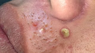 Suri Job 600 Good Blackheads Removal Around The Mouth [upl. by Enahsal728]