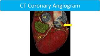 CT coronary angiogram [upl. by Puklich133]