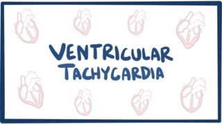 Ventricular tachycardia VT  causes symptoms diagnosis treatment amp pathology [upl. by Remliw]