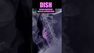 DISH  Diffuse Idiopathic Skeletal Hyperostosis xray cervical bones [upl. by Mattson]