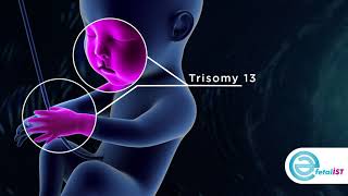 Trisomy 13 [upl. by Winola222]