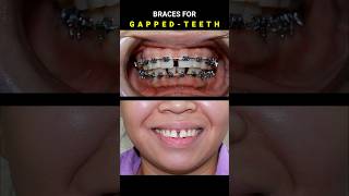 BRACES FOR GAPPED TEETH 32 MONTHS DURATION braces orthodontist dentist [upl. by Icrad471]