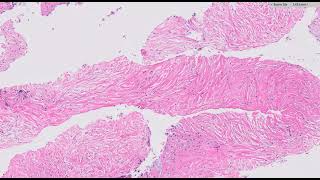 Pancreatic ductal adenocarcinoma  core biopsy [upl. by Giule]