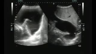 Ultrasound video of Collapsed lung tissue quotfloatingquot in the Pleural Effusion [upl. by Nyvrem]