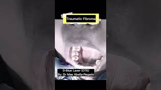 Traumatic Fibroma Laser Treatment  Dr Mae Abella [upl. by Annuahs]