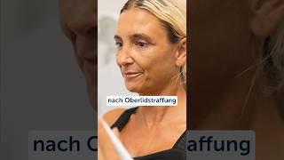 oberlidstraffung lidkorrektur lid straffung antiage düsseldorf plastischechirurgie [upl. by Kafka]