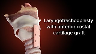 Medical Animation Anterior Cricoid Split  Cincinnati Childrens [upl. by Eibba]