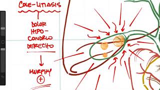 Resumen de la patología de la vía biliar [upl. by Nodnrb]