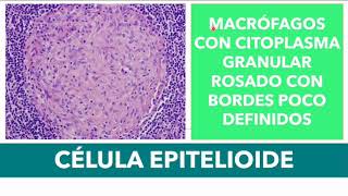 INFLAMACIÓN GRANULOMATOSA GRANULOMA ¿QUÉ ES CÓMO SE FORMA Y EJEMPLOS DE PATOLOGÍAS [upl. by Nohsyt]