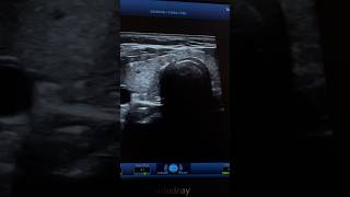 Hashimoto Tyroiditis Ultrasound  Hypothyroidism Sonography  ARDMS [upl. by Payson]