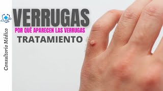 VERRUGAS  ¿Por qué aparecen las verrugas Tratamientos  👨‍⚕️ Consultorio Médico [upl. by Llertnahs]