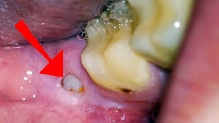 Wisdom Tooth Pain What you NEED to Know Oral Sedation Home Remedies and What to Expect [upl. by Jael]