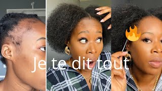 COMMENT FAIRE POUSSÉ SES CHEVEUX DU DEVANTAlopécieSolution Efficace [upl. by Varhol866]