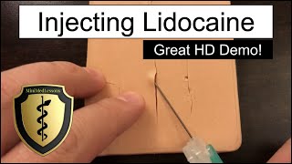 Injecting Lidocaine for a Laceration  HD Video Demonstration [upl. by Edwards776]