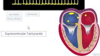 ECG Rhythm Review SVT Atrial Fibrillation Atrial Flutter [upl. by Gnuh]