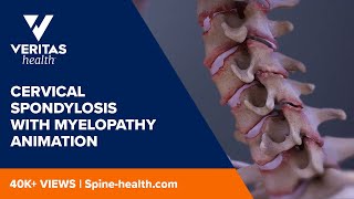 Cervical Spondylosis with Myelopathy Animation [upl. by Ahsitak843]