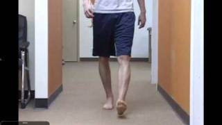 Clinical Gait Case Study Tibial Varum with Postop ACL complications [upl. by Azelea]