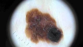 Moles and Melanoma [upl. by Airamak]