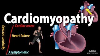 Cardiomyopathy animation [upl. by Aicilana]