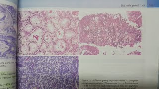 Prostatic Adenocarcinoma  SPECIAL PATHOLOGY [upl. by Shirline]